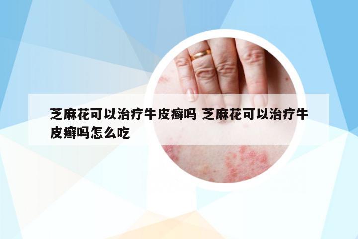 芝麻花可以治療牛皮癬嗎 芝麻花可以治療牛皮癬嗎怎么吃