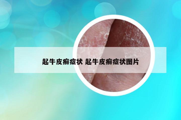 起牛皮癬癥狀 起牛皮癬癥狀圖片