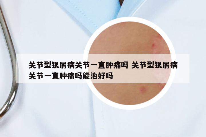 關(guān)節(jié)型銀屑病關(guān)節(jié)一直腫痛嗎 關(guān)節(jié)型銀屑病關(guān)節(jié)一直腫痛嗎能治好嗎