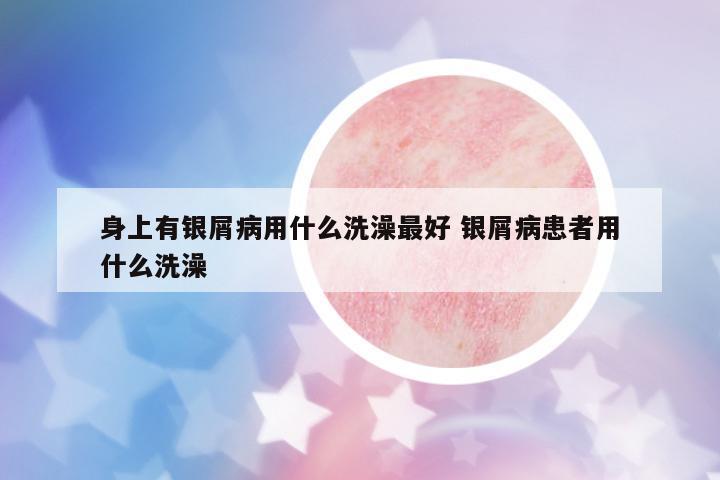 身上有銀屑病用什么洗澡最好 銀屑病患者用什么洗澡