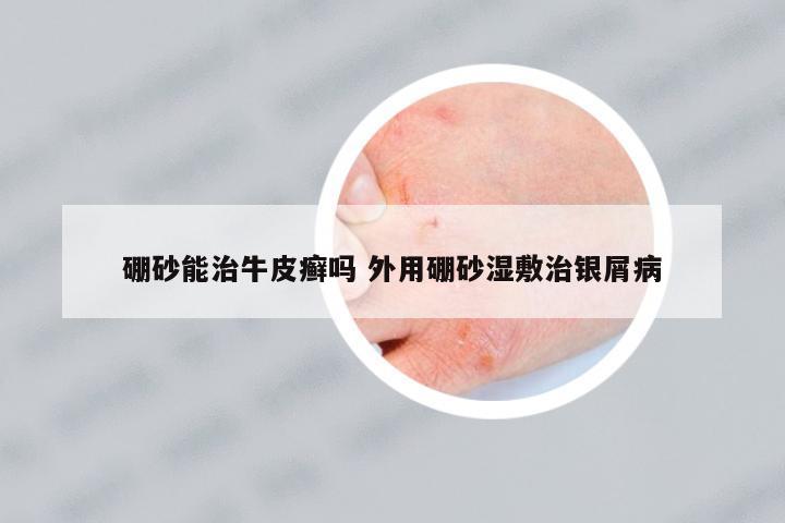 硼砂能治牛皮癬嗎 外用硼砂濕敷治銀屑病
