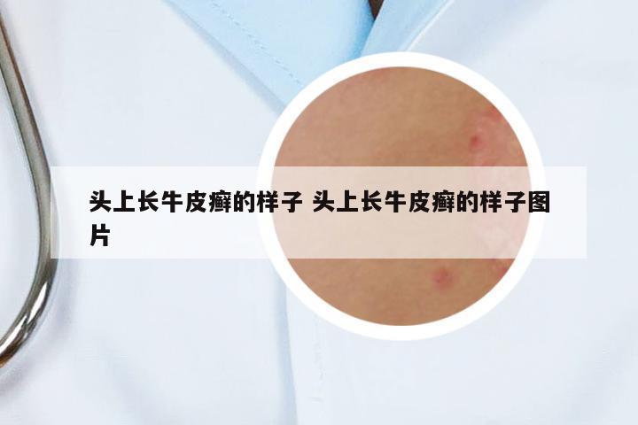 頭上長牛皮癬的樣子 頭上長牛皮癬的樣子圖片
