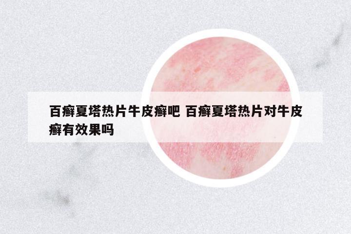 百癬夏塔熱片牛皮癬吧 百癬夏塔熱片對(duì)牛皮癬有效果嗎