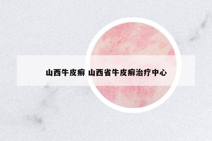 山西牛皮癬 山西省牛皮癬治療中心