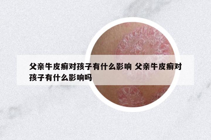 父親牛皮癬對孩子有什么影響 父親牛皮癬對孩子有什么影響嗎
