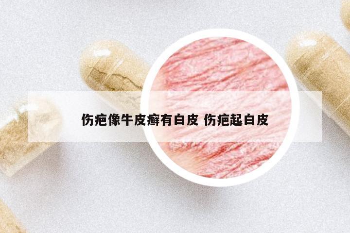 傷疤像牛皮癬有白皮 傷疤起白皮