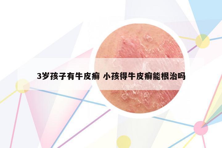 3歲孩子有牛皮癬 小孩得牛皮癬能根治嗎
