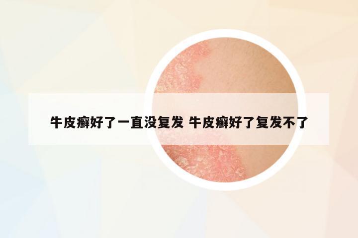 牛皮癬好了一直沒復發(fā) 牛皮癬好了復發(fā)不了