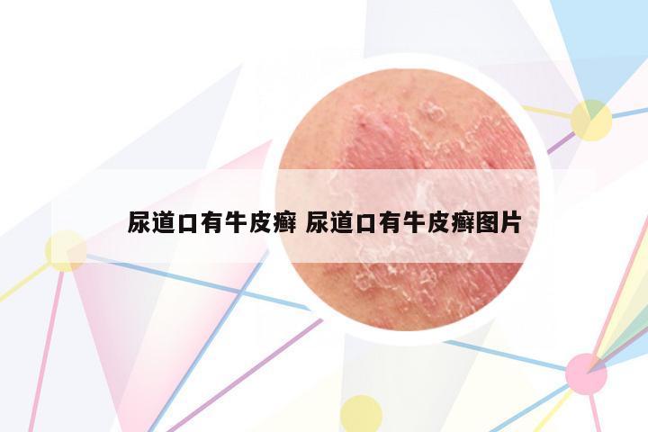 尿道口有牛皮癬 尿道口有牛皮癬圖片