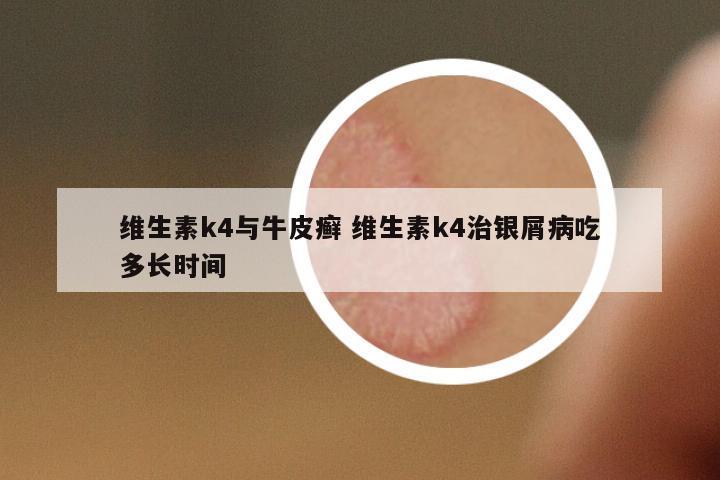 維生素k4與牛皮癬 維生素k4治銀屑病吃多長(zhǎng)時(shí)間