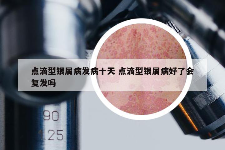 點(diǎn)滴型銀屑病發(fā)病十天 點(diǎn)滴型銀屑病好了會(huì)復(fù)發(fā)嗎