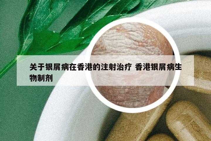 關(guān)于銀屑病在香港的注射治療 香港銀屑病生物制劑