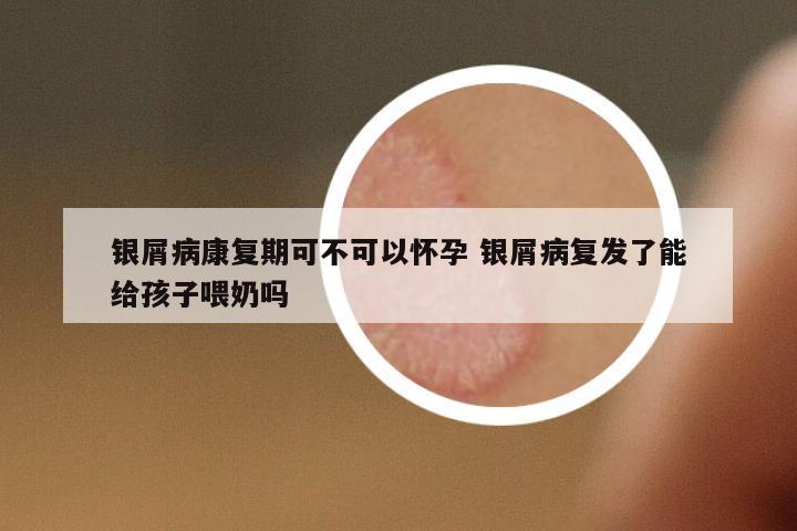銀屑病康復期可不可以懷孕 銀屑病復發(fā)了能給孩子喂奶嗎