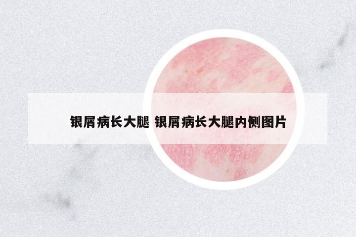 銀屑病長(zhǎng)大腿 銀屑病長(zhǎng)大腿內(nèi)側(cè)圖片