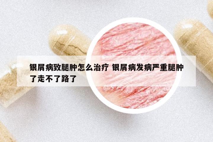 銀屑病致腿腫怎么治療 銀屑病發(fā)病嚴(yán)重腿腫了走不了路了