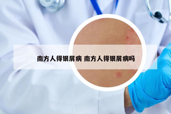 南方人得銀屑病 南方人得銀屑病嗎