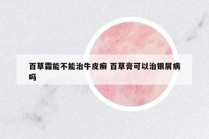 百草霜能不能治牛皮癬 百草膏可以治銀屑病嗎