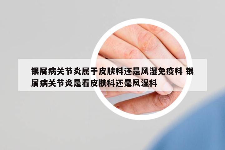 銀屑病關(guān)節(jié)炎屬于皮膚科還是風(fēng)濕免疫科 銀屑病關(guān)節(jié)炎是看皮膚科還是風(fēng)濕科