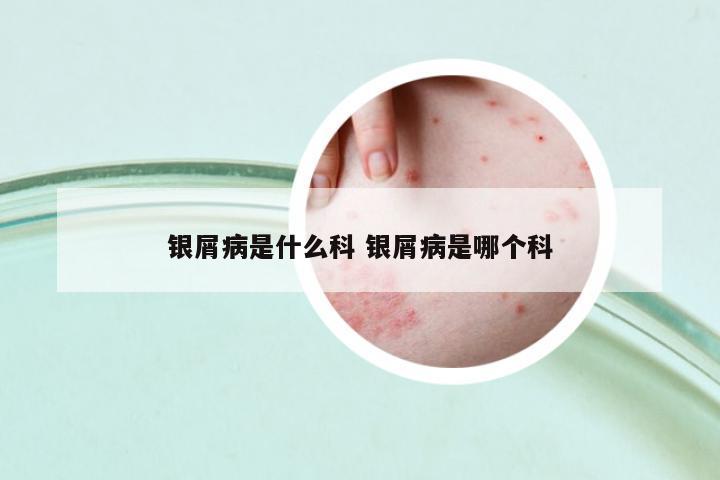 銀屑病是什么科 銀屑病是哪個(gè)科