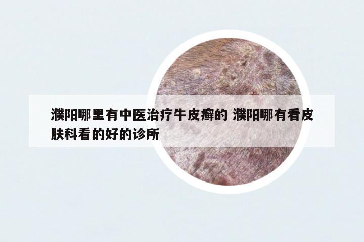 濮陽(yáng)哪里有中醫(yī)治療牛皮癬的 濮陽(yáng)哪有看皮膚科看的好的診所