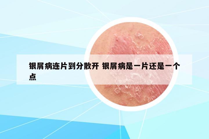 銀屑病連片到分散開(kāi) 銀屑病是一片還是一個(gè)點(diǎn)