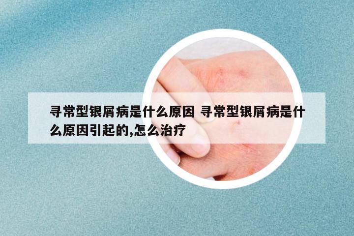 尋常型銀屑病是什么原因 尋常型銀屑病是什么原因引起的,怎么治療