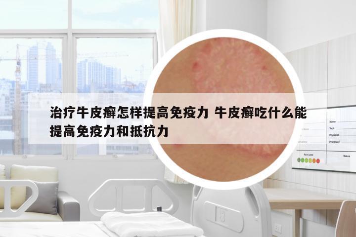 治療牛皮癬怎樣提高免疫力 牛皮癬吃什么能提高免疫力和抵抗力