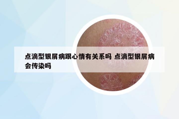 點滴型銀屑病跟心情有關系嗎 點滴型銀屑病會傳染嗎