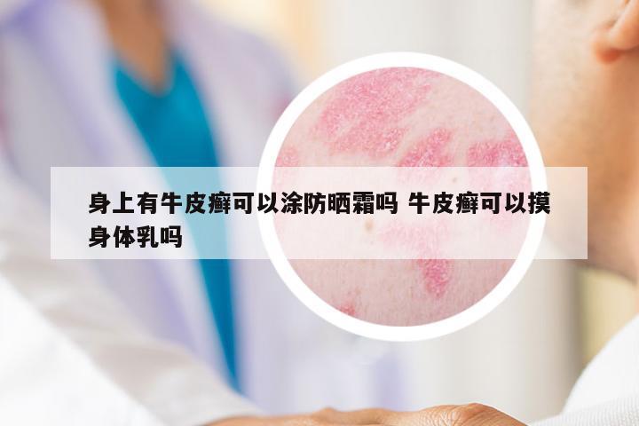 身上有牛皮癬可以涂防曬霜嗎 牛皮癬可以摸身體乳嗎