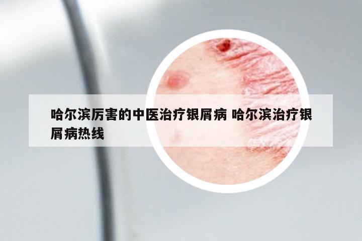 哈爾濱厲害的中醫(yī)治療銀屑病 哈爾濱治療銀屑病熱線