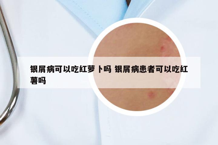 銀屑病可以吃紅蘿卜嗎 銀屑病患者可以吃紅薯嗎