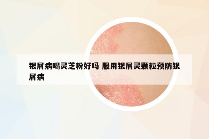 銀屑病喝靈芝粉好嗎 服用銀屑靈顆粒預(yù)防銀屑病