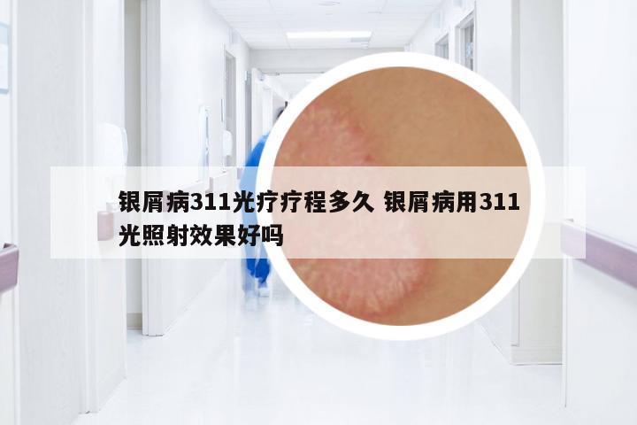 銀屑病311光療療程多久 銀屑病用311光照射效果好嗎