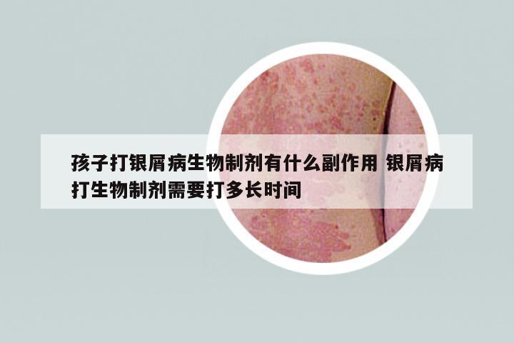 孩子打銀屑病生物制劑有什么副作用 銀屑病打生物制劑需要打多長時間