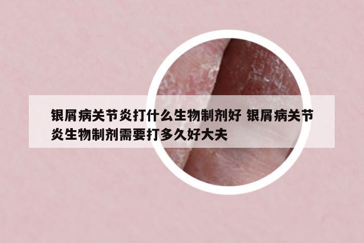 銀屑病關節(jié)炎打什么生物制劑好 銀屑病關節(jié)炎生物制劑需要打多久好大夫