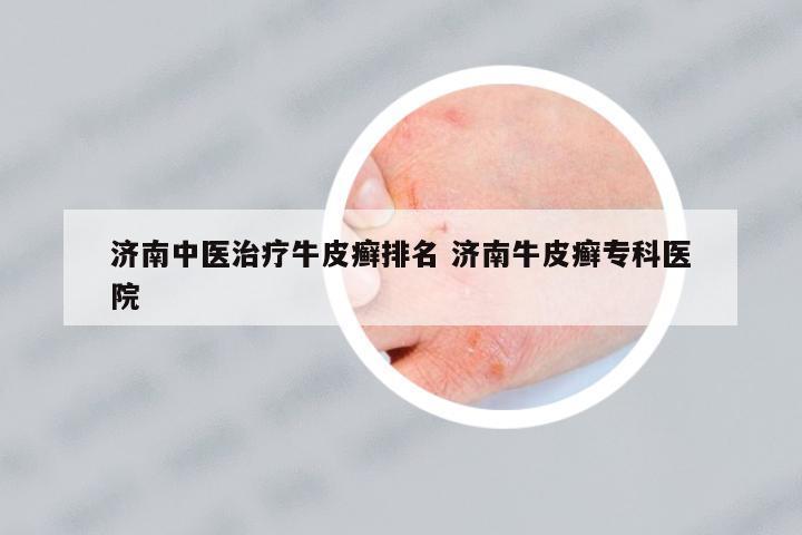 濟(jì)南中醫(yī)治療牛皮癬排名 濟(jì)南牛皮癬專(zhuān)科醫(yī)院
