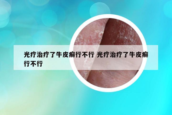 光療治療了牛皮癬行不行 光療治療了牛皮癬行不行