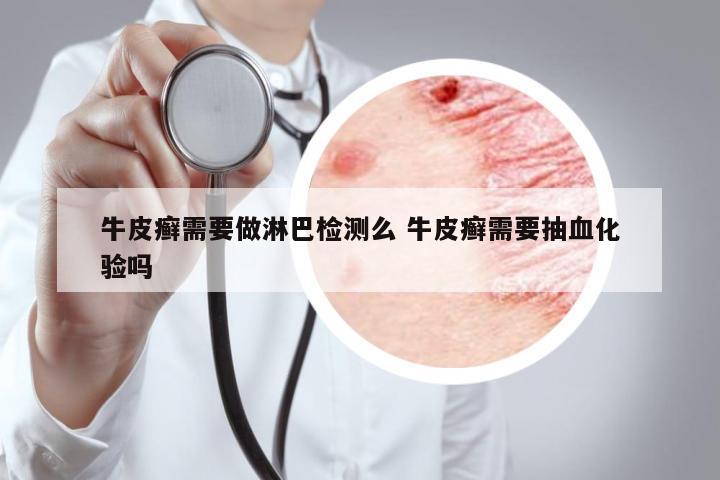 牛皮癬需要做淋巴檢測么 牛皮癬需要抽血化驗嗎