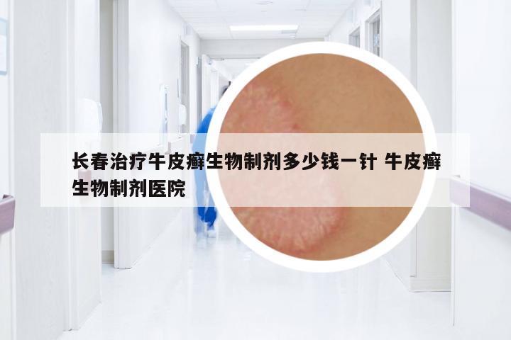 長春治療牛皮癬生物制劑多少錢一針 牛皮癬生物制劑醫(yī)院