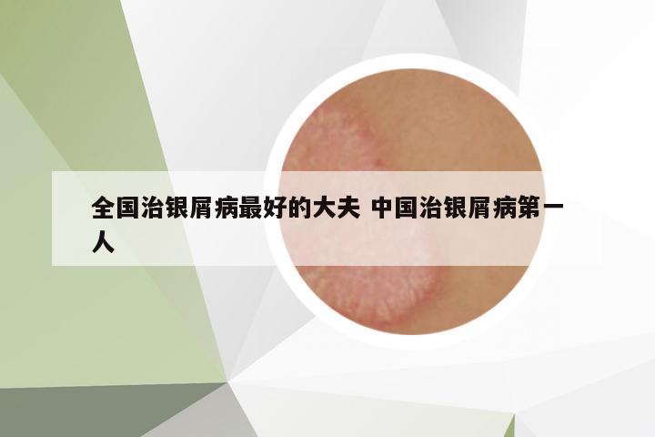 全國治銀屑病最好的大夫 中國治銀屑病第一人
