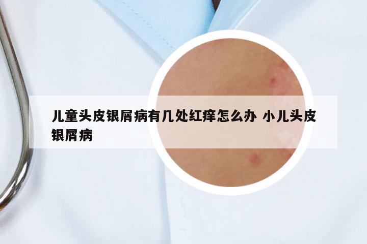 兒童頭皮銀屑病有幾處紅癢怎么辦 小兒頭皮銀屑病