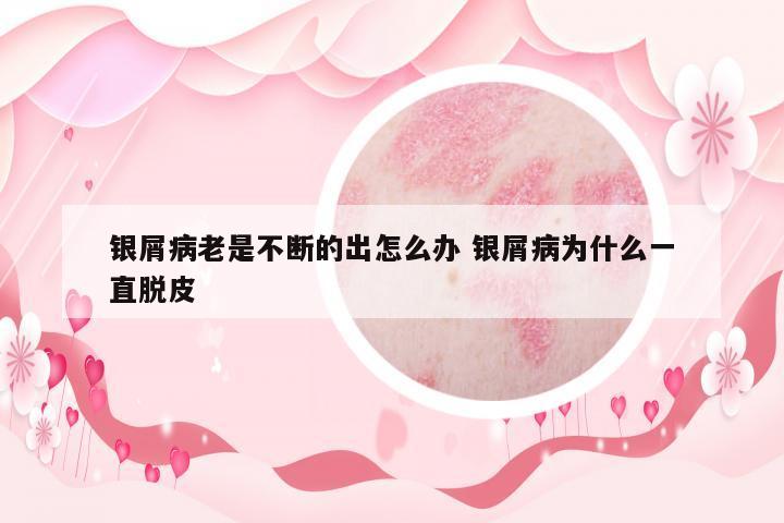 銀屑病老是不斷的出怎么辦 銀屑病為什么一直脫皮