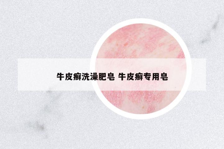 牛皮癬洗澡肥皂 牛皮癬專用皂