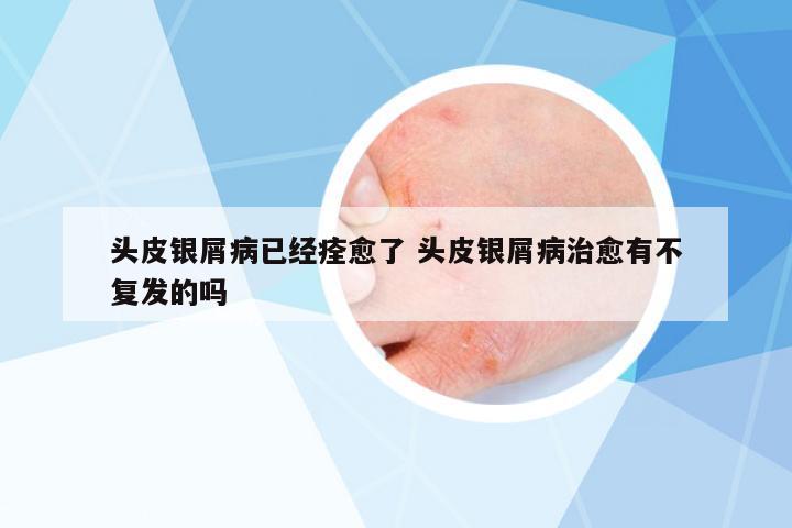 頭皮銀屑病已經痊愈了 頭皮銀屑病治愈有不復發(fā)的嗎