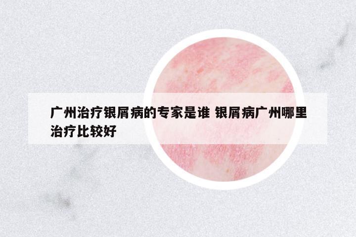 廣州治療銀屑病的專家是誰(shuí) 銀屑病廣州哪里治療比較好