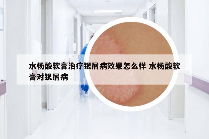 水楊酸軟膏治療銀屑病效果怎么樣 水楊酸軟膏對銀屑病
