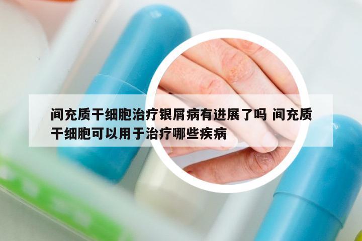 間充質(zhì)干細胞治療銀屑病有進展了嗎 間充質(zhì)干細胞可以用于治療哪些疾病