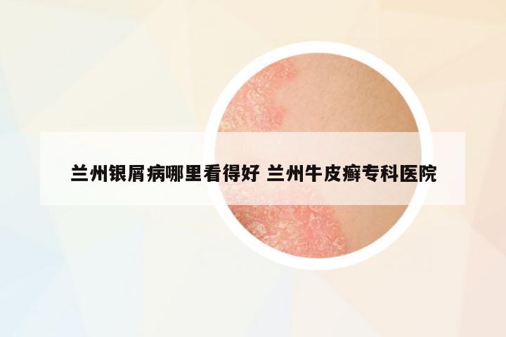 蘭州銀屑病哪里看得好 蘭州牛皮癬專科醫(yī)院