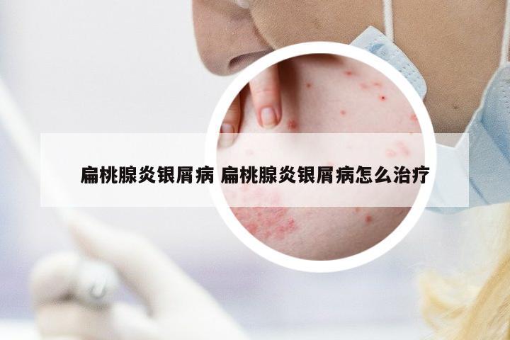 扁桃腺炎銀屑病 扁桃腺炎銀屑病怎么治療