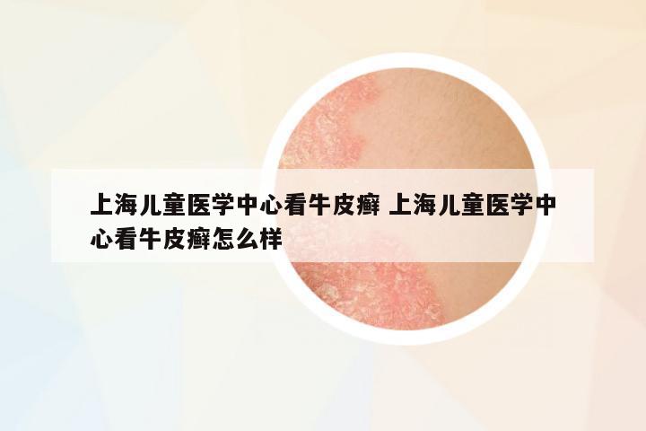 上海兒童醫(yī)學(xué)中心看牛皮癬 上海兒童醫(yī)學(xué)中心看牛皮癬怎么樣